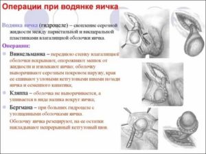 Как вылечить водянку яичка у ребенка без операции народными средствами