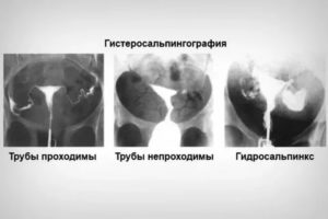 На какой день цикла проверяют проходимость маточных труб на узи