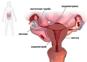 Если не лечит эндометриоз он может пройти сам