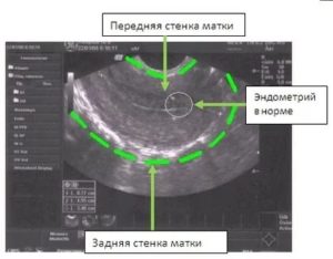 Узи тонкие стенки матки