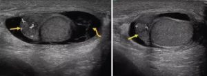 Гематоцеле яичка узи картины