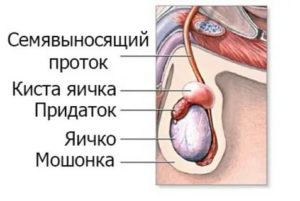 Рак придатка яичка симптомы у женщин