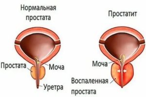 Может ли при простатите быть выделения из члена