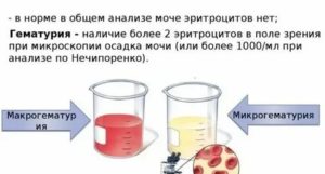Могут ли быть сгустки крови в моче при цистите