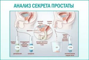 Почему после массажа простаты нельзя сдавать спермограмму в