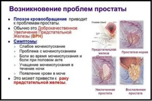 Жжение в области предстательной железы у мужчин