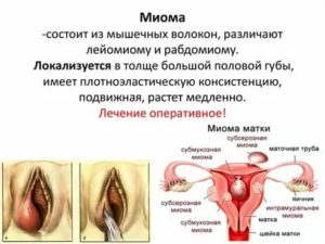 Как снять опухоль с половой губы внутренней