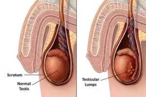 Что делать если у мужчины на одном яичке на одном из них опухоль