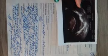 Сколько времени может быть задержка месячных при кисте яичника