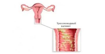 Что такое трихомонадный вагинит и чем это лечится