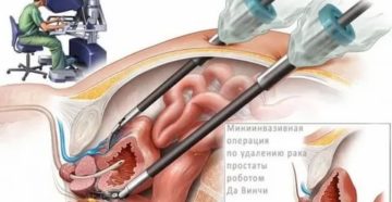 Можно ли посещать баню после удаления рака простаты