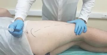 Можно ли делать плазмолифтинг во время месячных