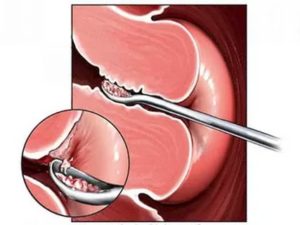 Гистероскопия матки удаление полипа в цервикальном канале