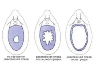 Как восстановить девственную плеву без операций