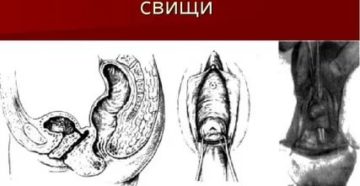 Как делают операцию по пузырно-влагалищный свищ