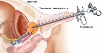 Лечение аденомы простаты с можжевельником