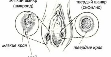 Что лучше мягкий шанкр или твердый