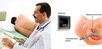 Слабительное перед узи простаты