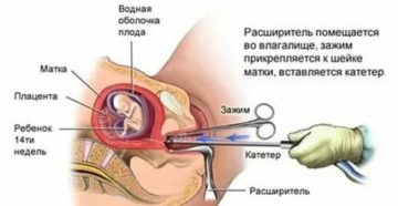 В чем причина скудных месячных после выскабливания
