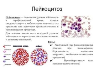 При простатите может быть повышенный уровень лейкоцитов