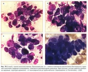 Цитологическая картина карциномы молочной железы