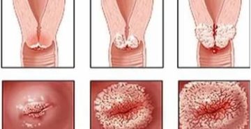 Что такое молочница хламидиоз эрозия шейки матки