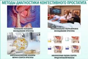 Признаки конгестивного простатита что это такое