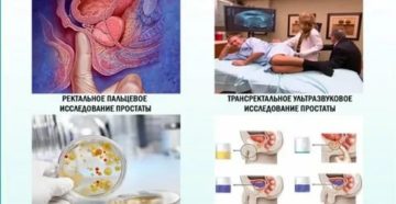 Признаки конгестивного простатита что это такое