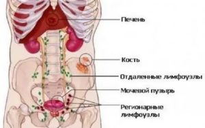 Метастазы в почки при раке предстательной железы