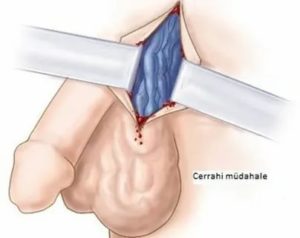 Как делают операцию на яичках если они маленькие