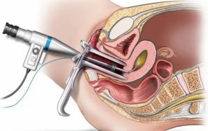 Гистероскопия что это такое в гинекологии стоимость