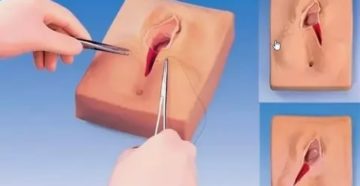 Можно ли уменьшить малые половые губы без операции