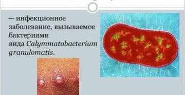 Диагностика паховой гранулемы