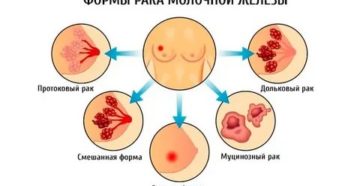 Аднексэктомия при раке молочной железы