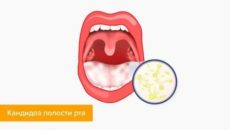 История болезни по кандидозу полости рта