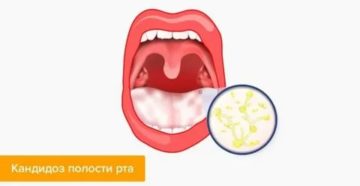 История болезни по кандидозу полости рта