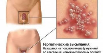 Может ли вирус герпеса вызывать молочницу