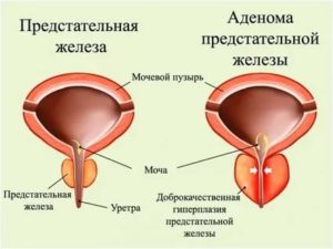 Можно ли применять ванну при аденоме простаты