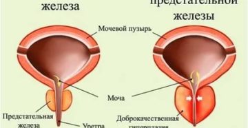 Можно ли применять ванну при аденоме простаты