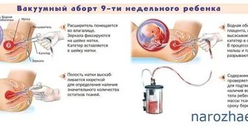 Почему нет месячных после вакуумного прерывания беременности Почему нет месячных после вакуумного прерывания беременности