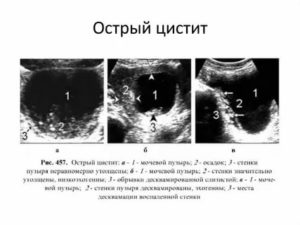 Что может показать узи мочевого пузыря и почек при цистите