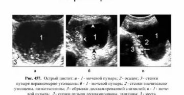 Что может показать узи мочевого пузыря и почек при цистите