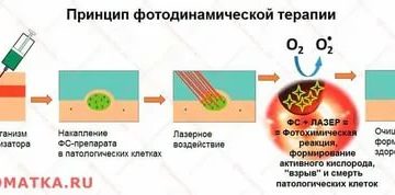 Фотосенсибилизация при раке шейки матки