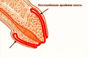 Что такое на члене головки красная опухоль