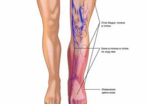 Могут ли болеть вены на ногах при месячных