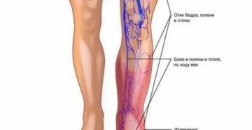Могут ли болеть вены на ногах при месячных