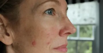 Как избавиться от прыщей в период менопаузы