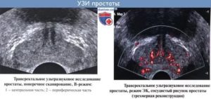 Междолевая борозда предстательной железы выражена