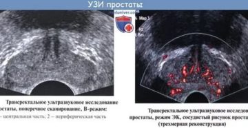 Междолевая борозда предстательной железы выражена