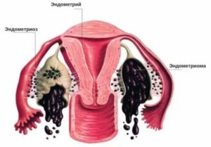 Перерождение эндометриоза в злокачественную опухоль симптомы